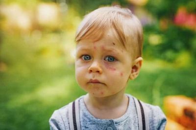 What Causes Baby Acne On Face